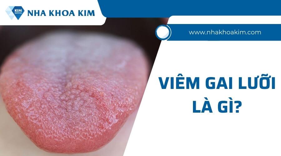 Viêm gai lưỡi là gì?