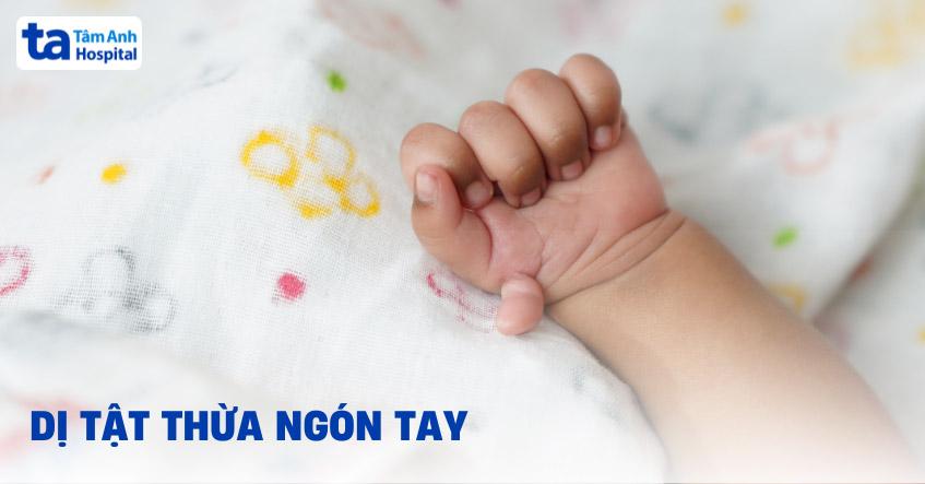 dị tật thừa ngón tay